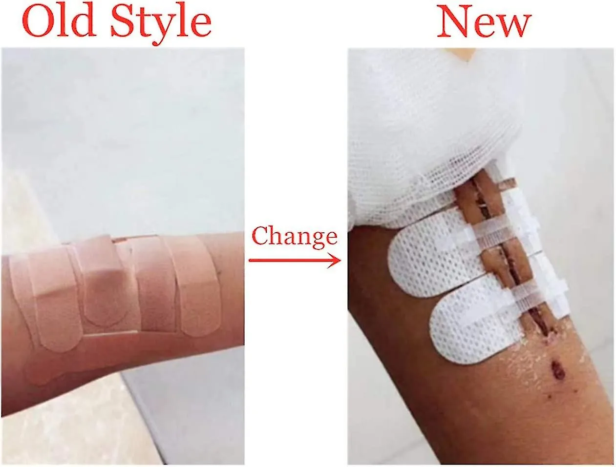 EMERGENCY WOUND CLOSURES BANDAID ADHESIVE BANDAGES, ZIP STITCH STICKERS FOR CAMPING, SURVIVAL & HOUSEHOLD GEAR, 3 PCS (45*1